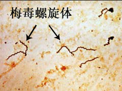 阜阳预防梅毒要怎么做